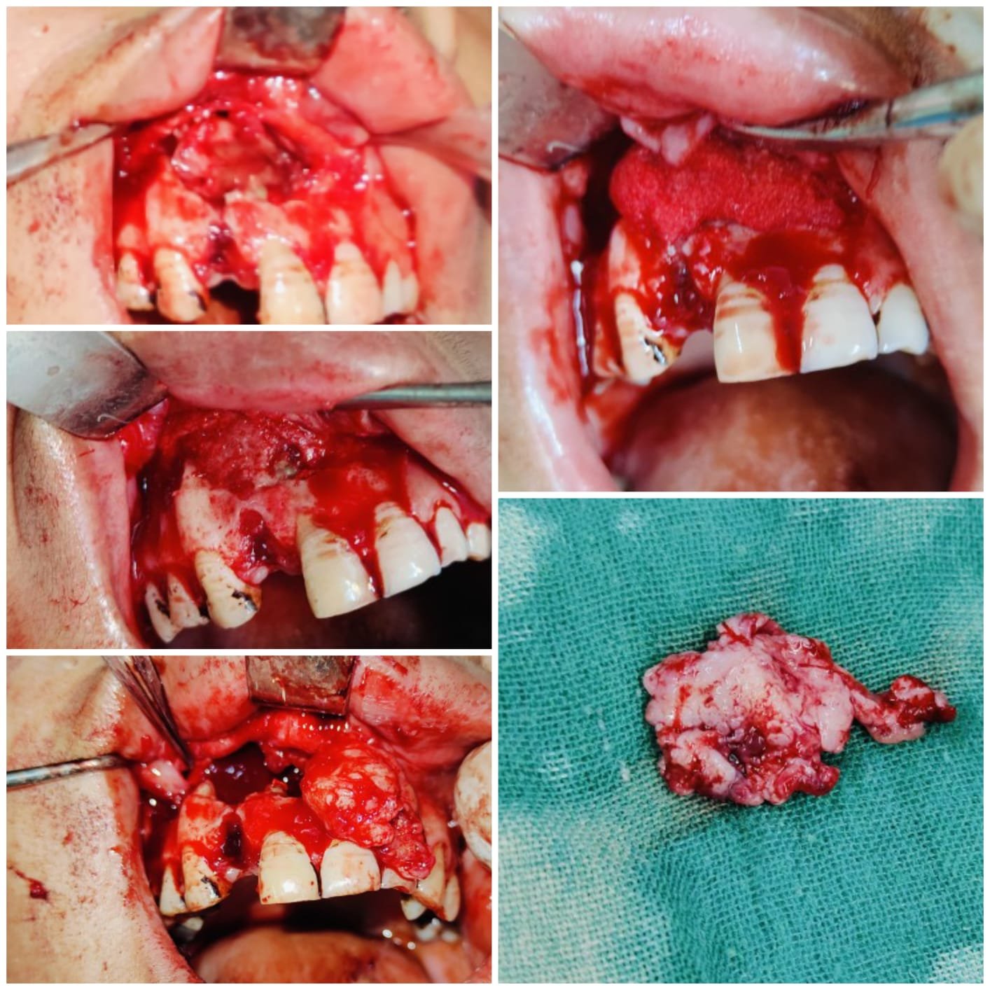 cyst enucleation